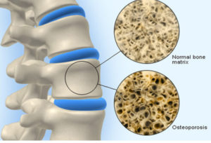 colonna osteoporosi